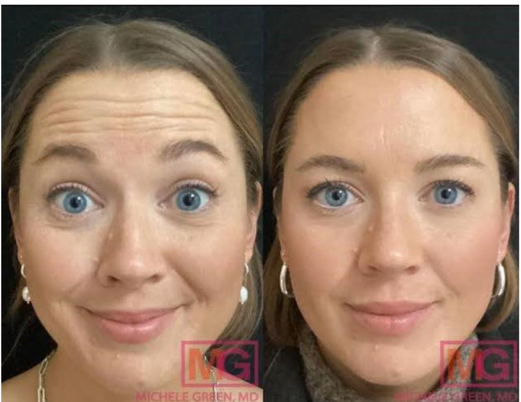 Botulinum Toxin (Botox)