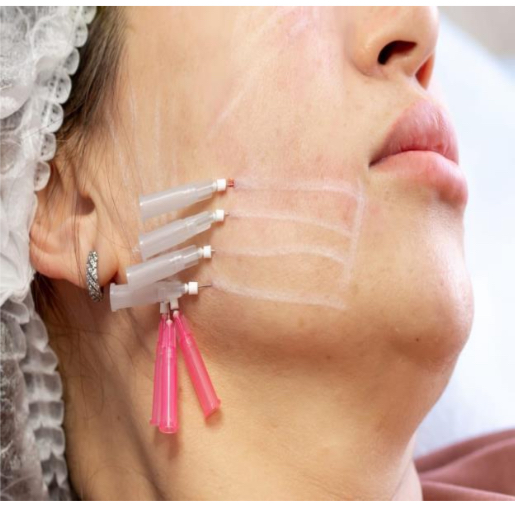 Thread Lift