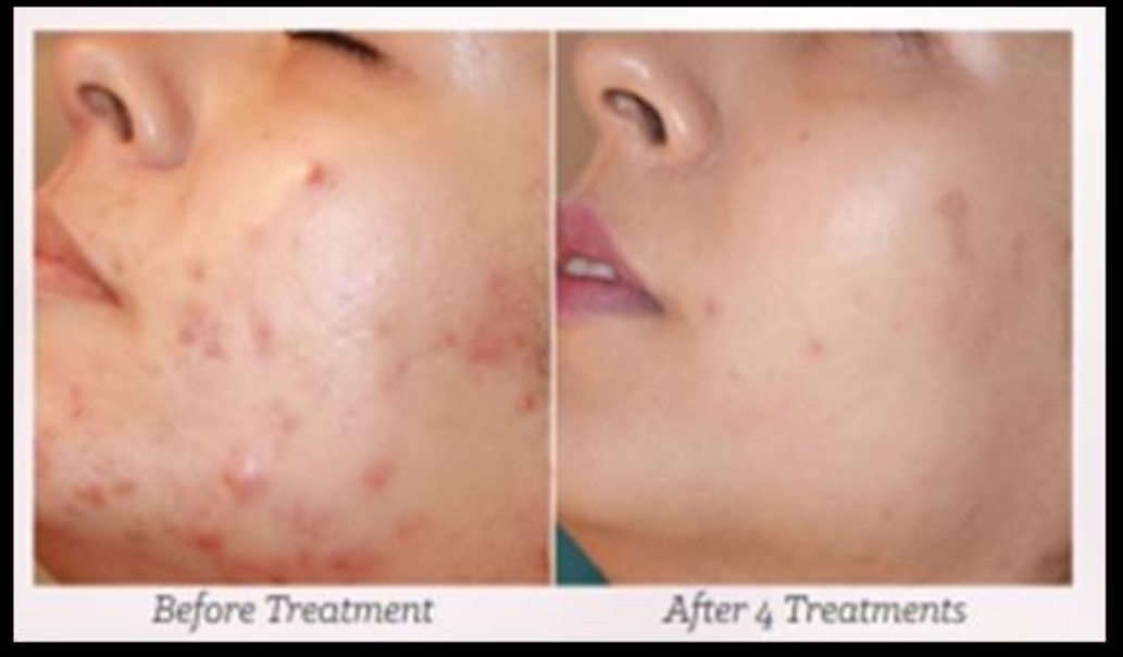 Mesotherapy