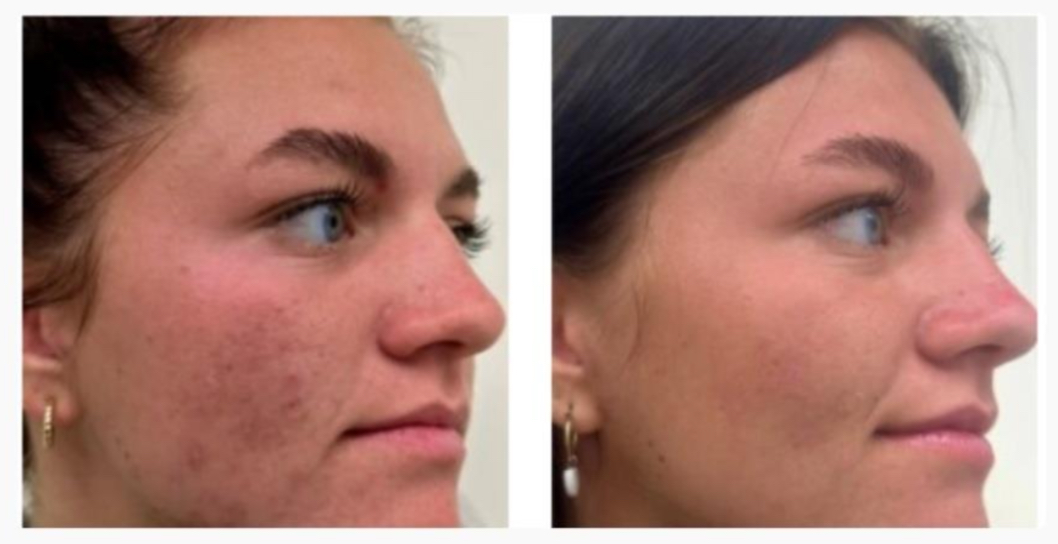 Dermapen