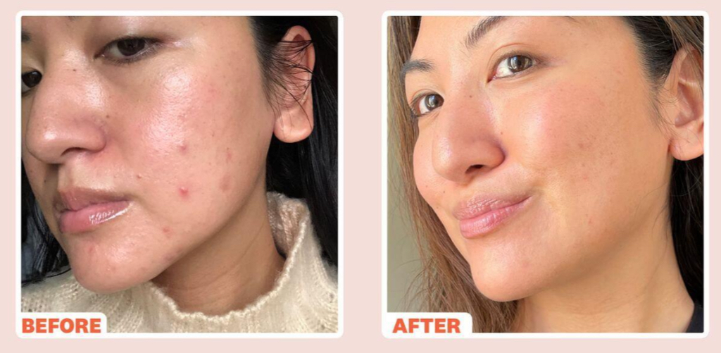 Microneedling Radio Frequency (MNRF)