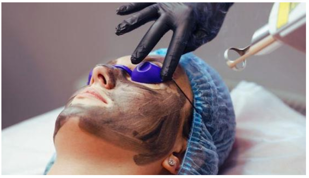 Carbon Laser Peel