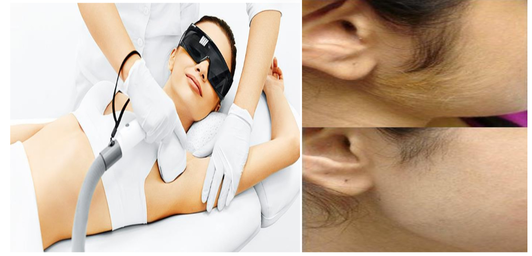 Hair Removal