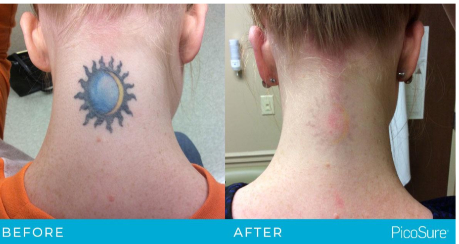 Tattoo Removal
