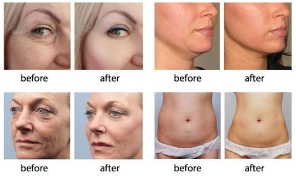 Skin Tightening Treatment