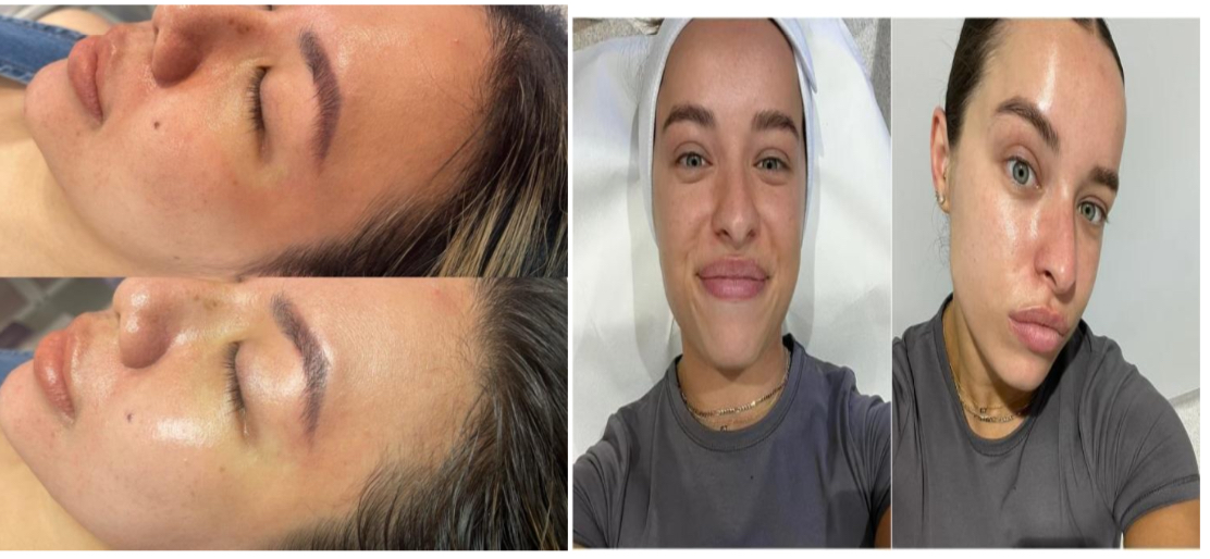 Hydra Facial