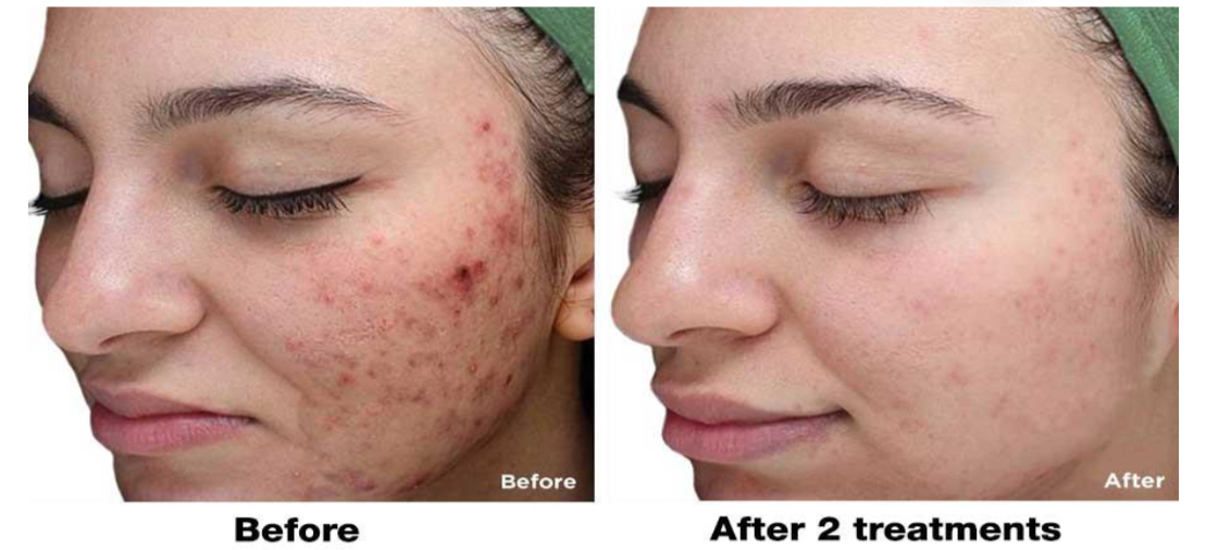 Chemical Peel