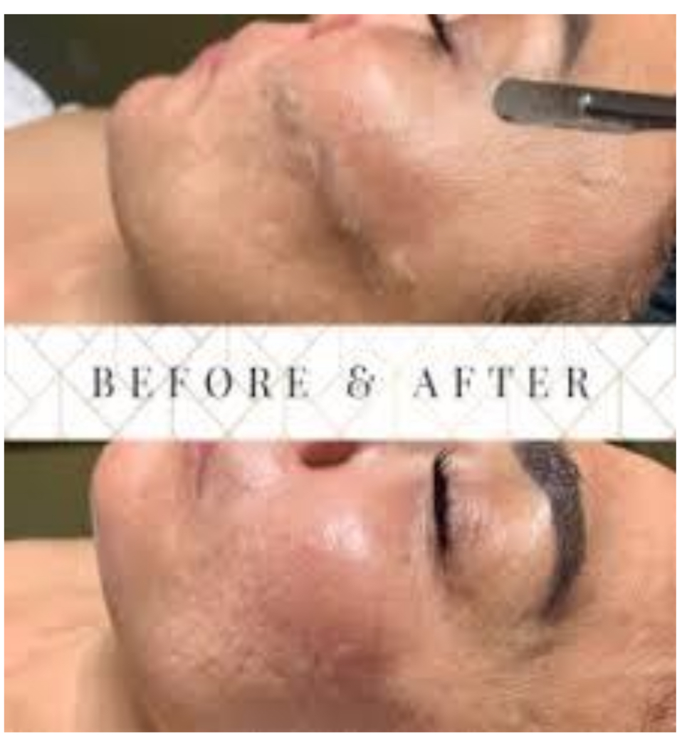 Dermaplaning