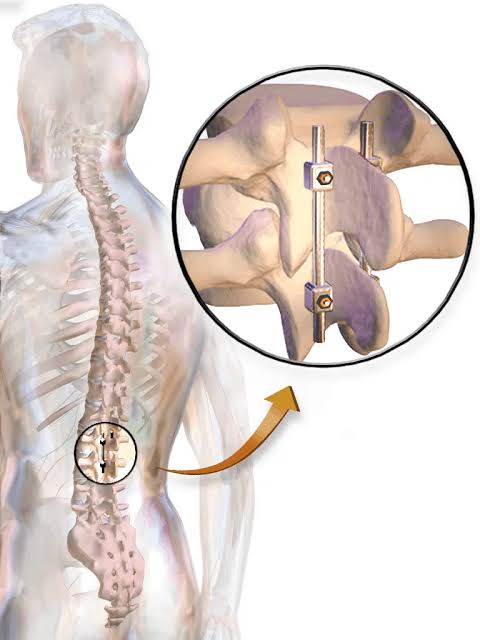 Degenerative disc Surgery