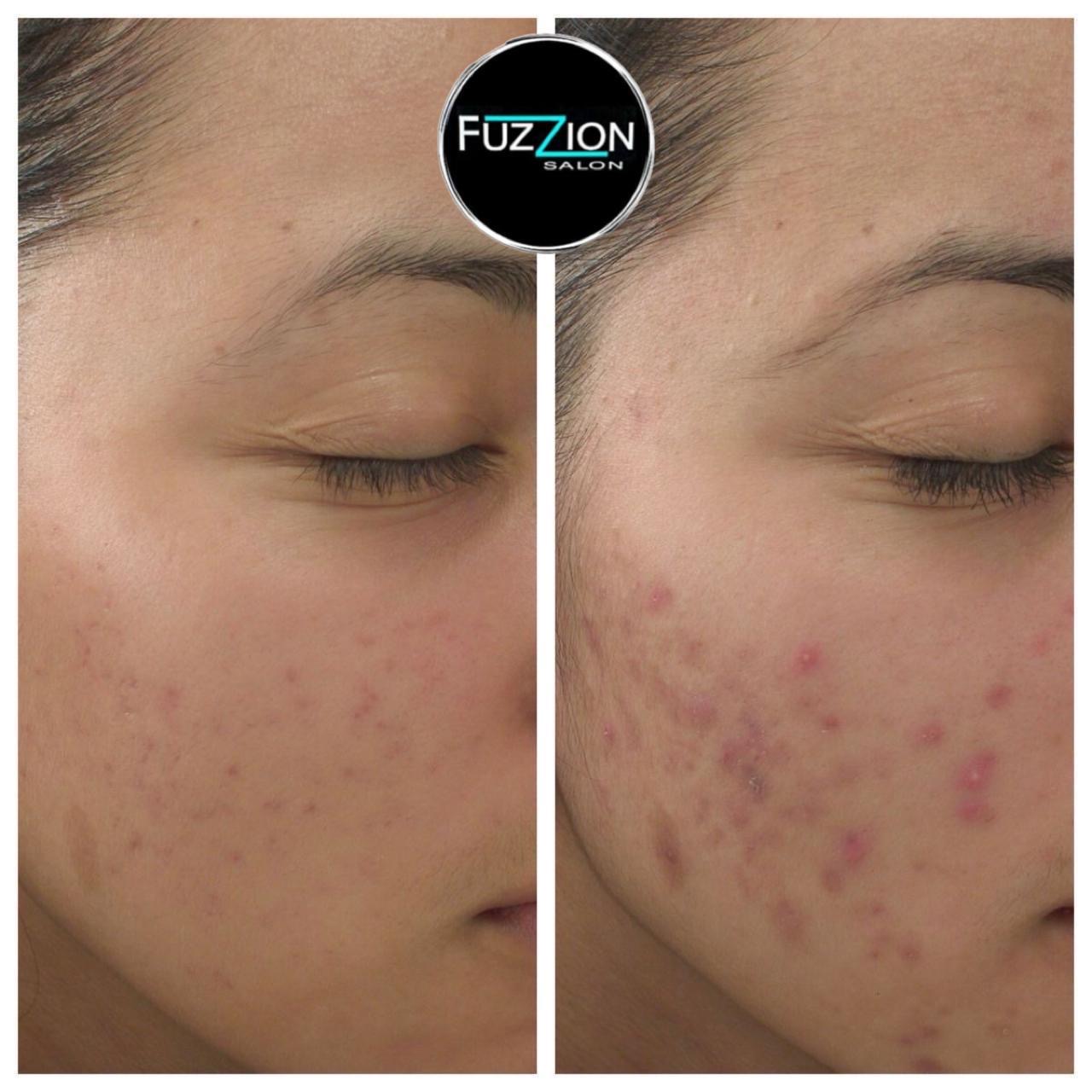Skin treatment