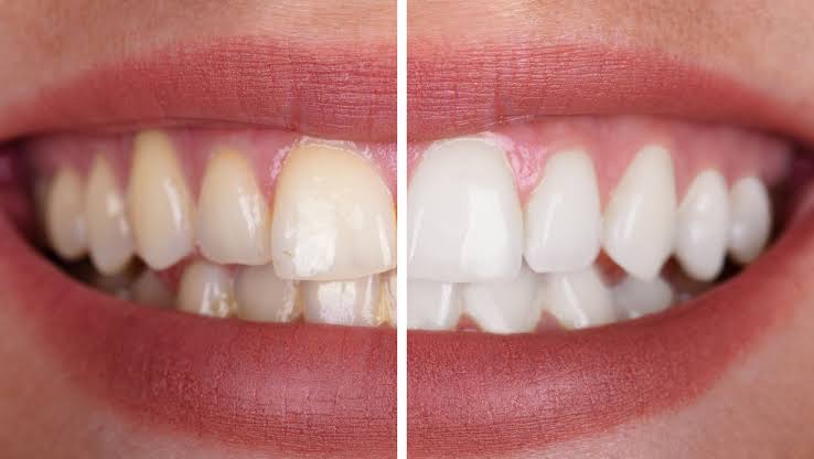 Teeth cleaning