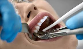 Tooth Extraction