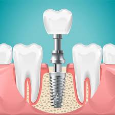 Dental implant