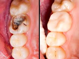 Restoration (Filling)