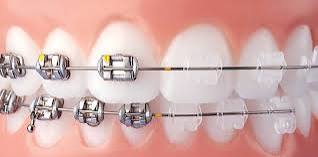Orthodontic Treatment