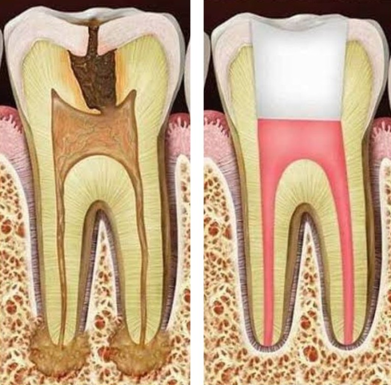 Root Canal Treatment (RCT)