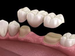Fixed Crowns