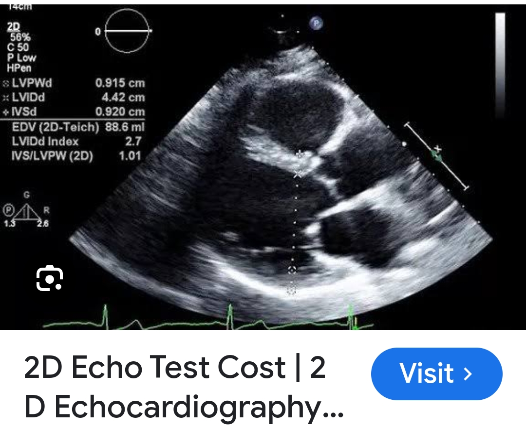 2D ECO &COLOUR DOPPLER