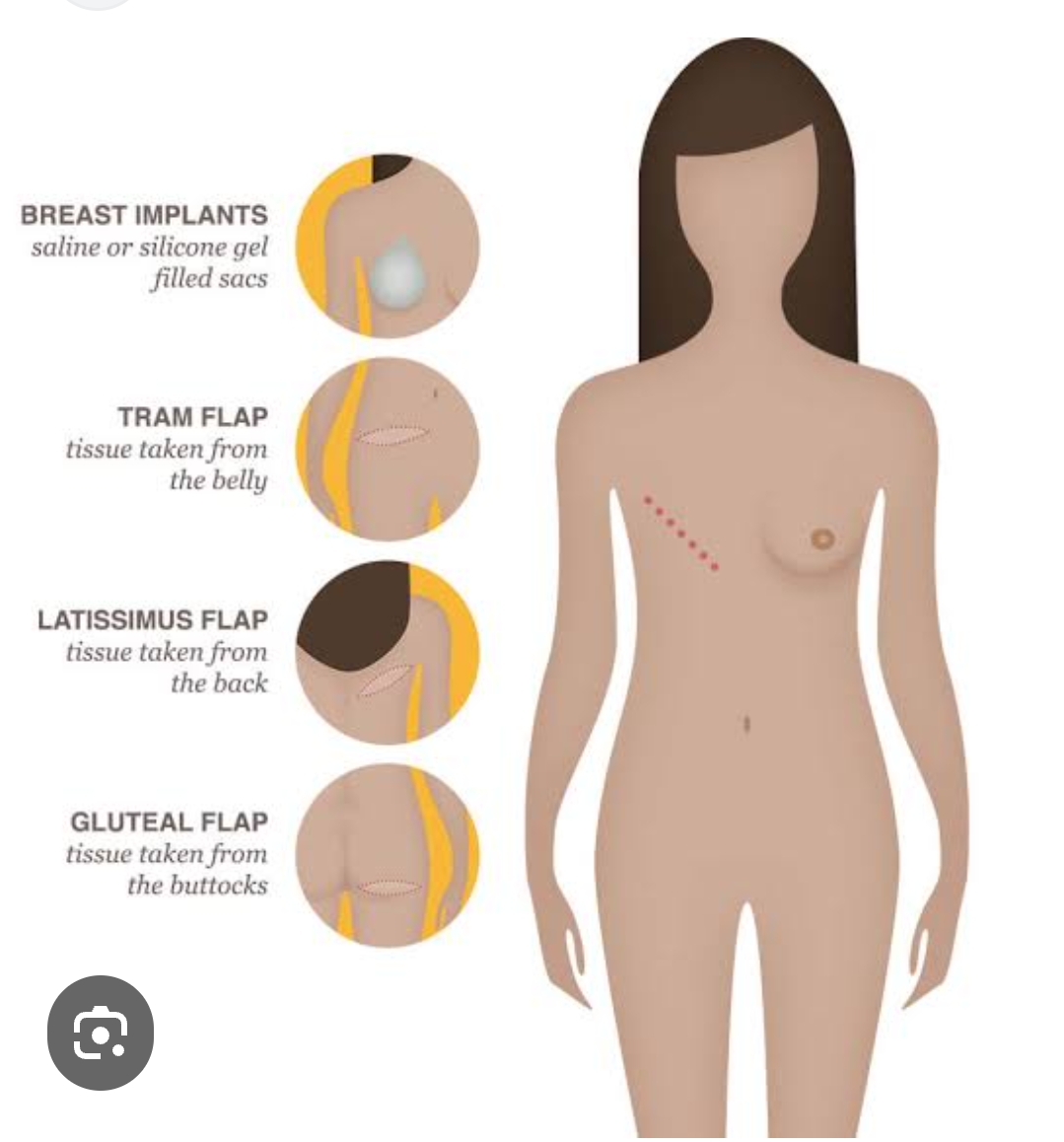 Cancer and reconstruction surgeries