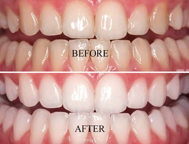 BLEACHING