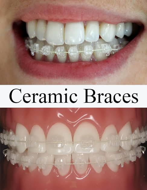 CERAMIC BRACKETS