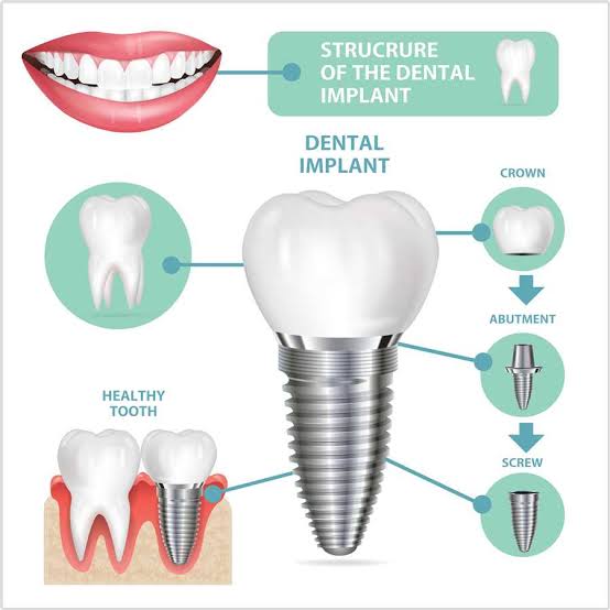 DENTAL IMPLANTS