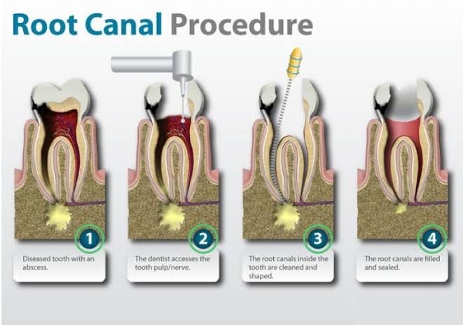 Single Sitting Root canal Treatment