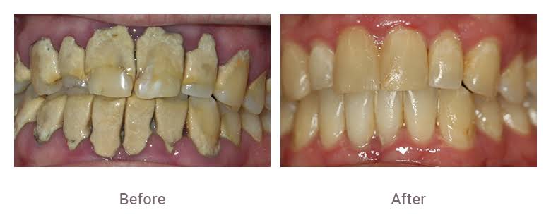Teeth Cleaning And Polishing (SCALING)