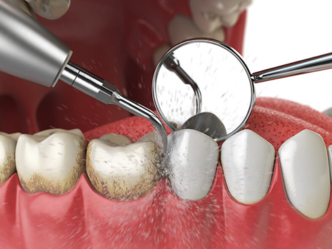 Oral prophylaxis