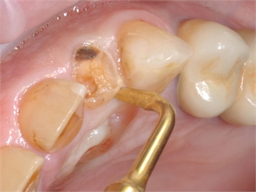 Surgical Extractions