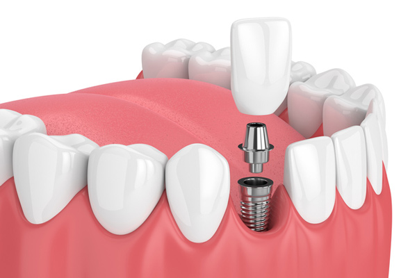 Implants