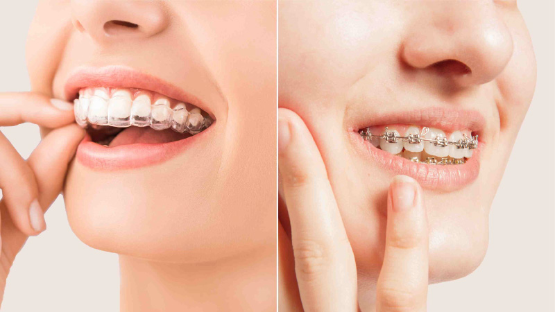 Orthodontic/Orthognathic and Aligners
