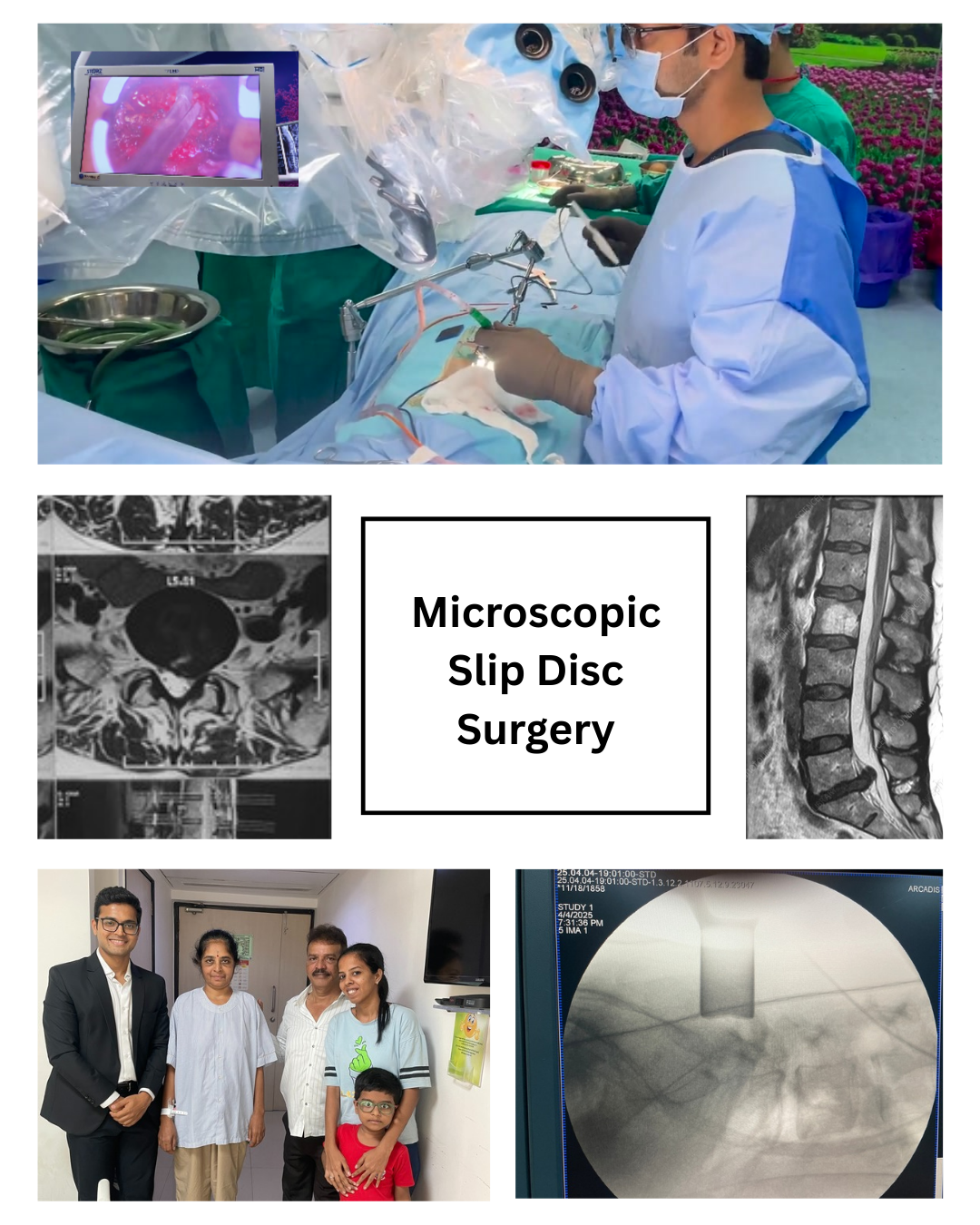 Slip Disc Surgery - MicroEndoscopic Surgery