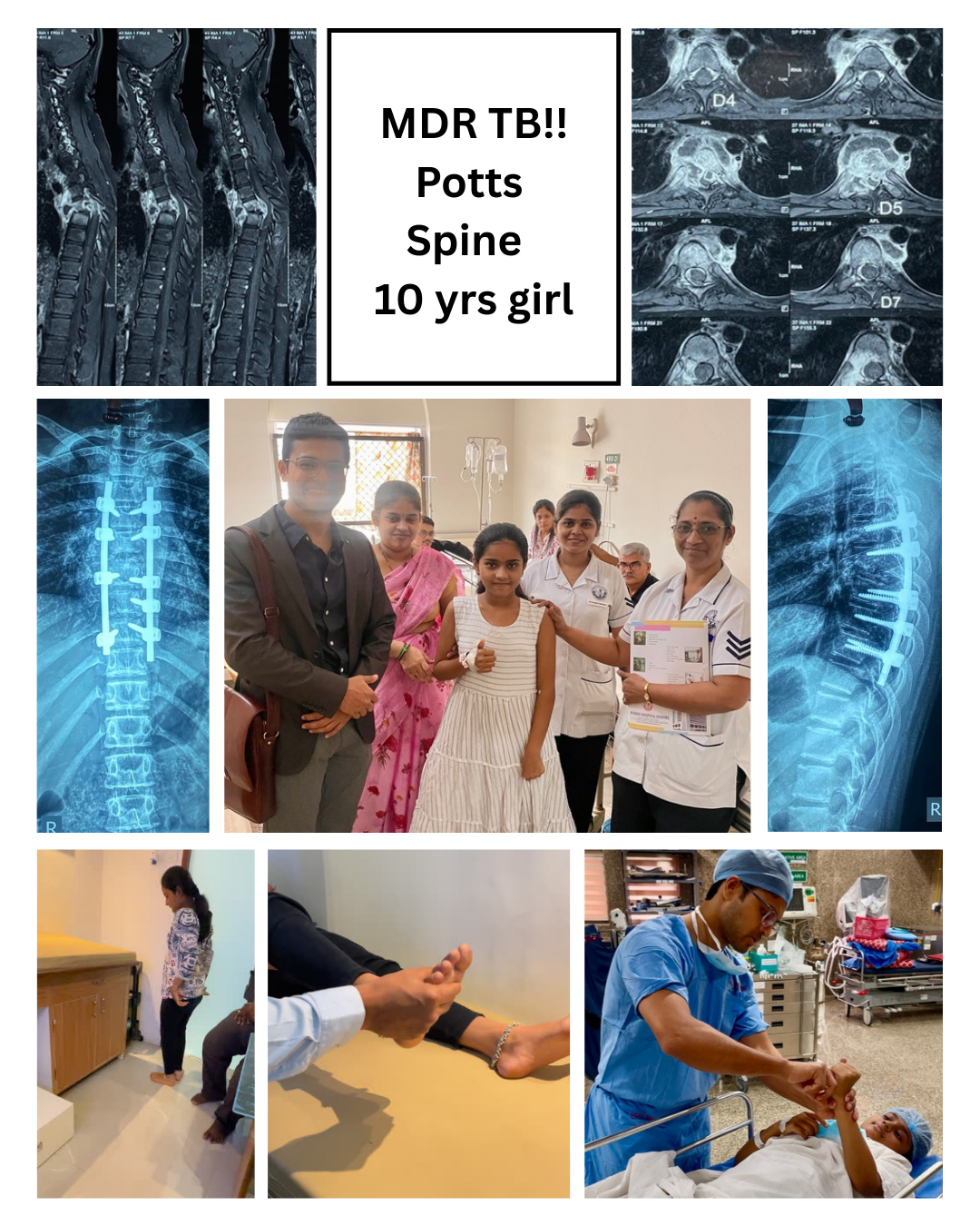 Microscopic TB Spine Surgery