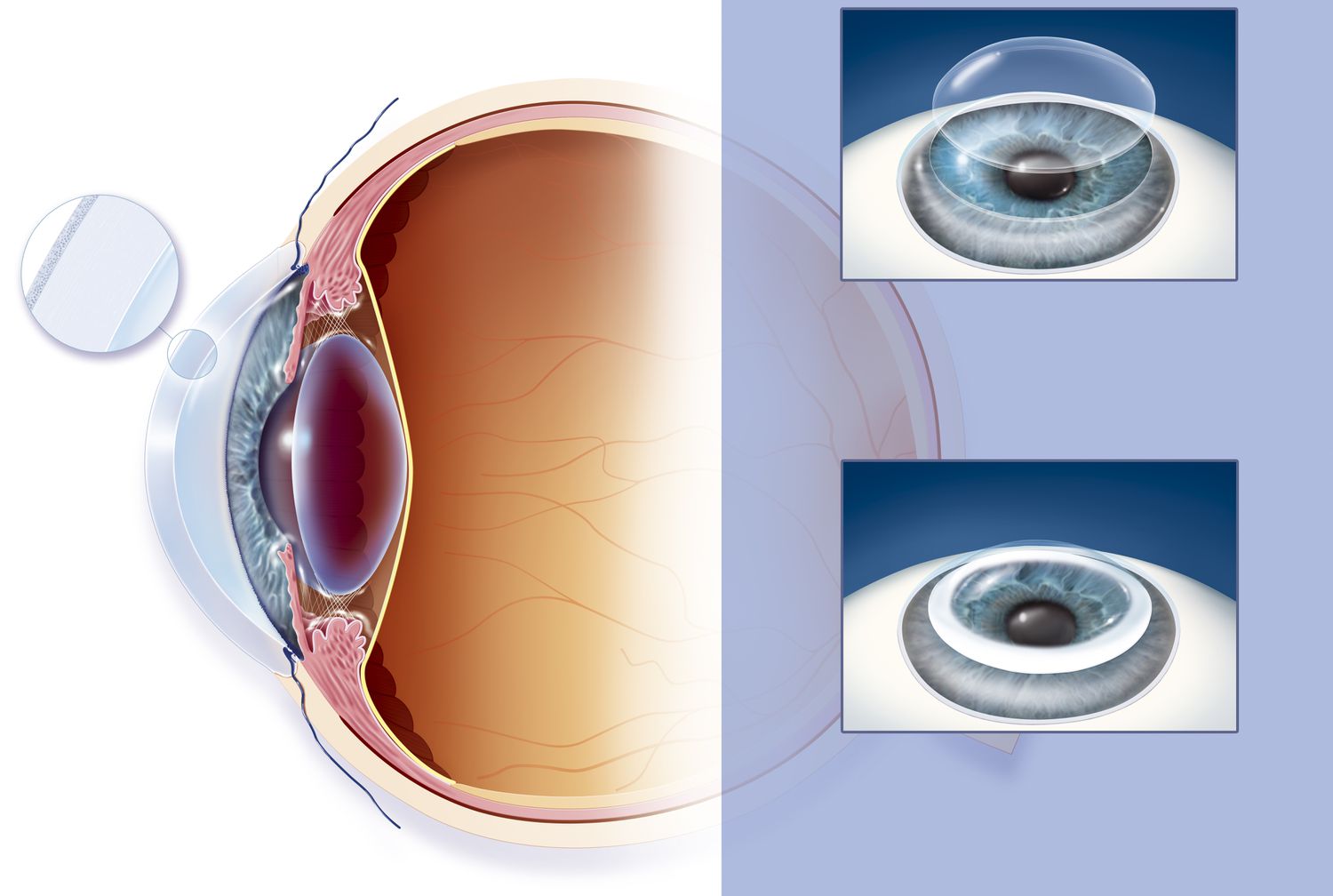 Corneal Services