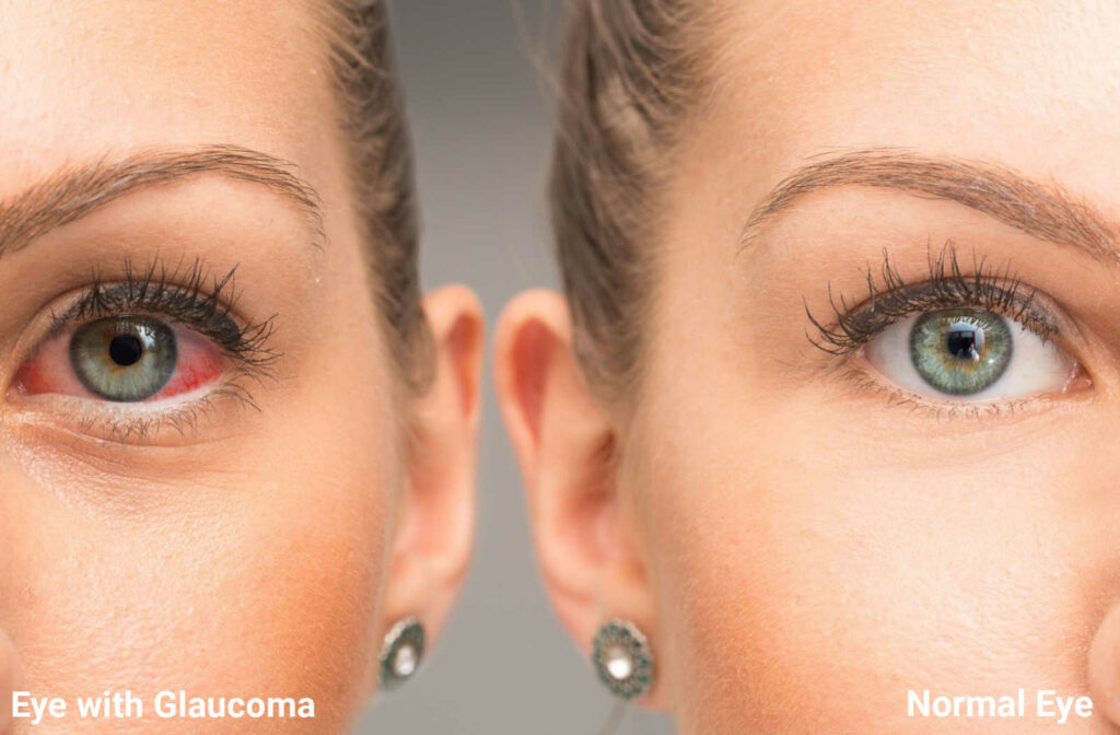 Glaucoma