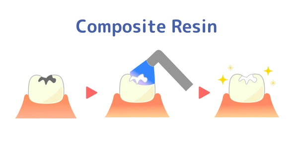 Composite Restoration