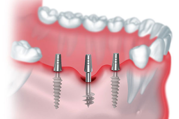 Cortico-Basal implants