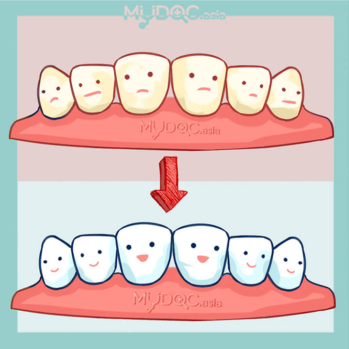 Teeth whitening
