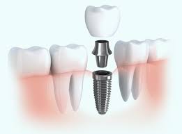 Conventional Implants