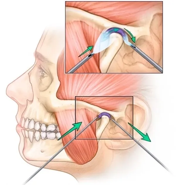 TMJ Arthocentesis (Lavage)