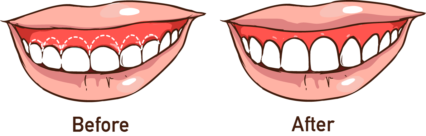 Gum Contouring