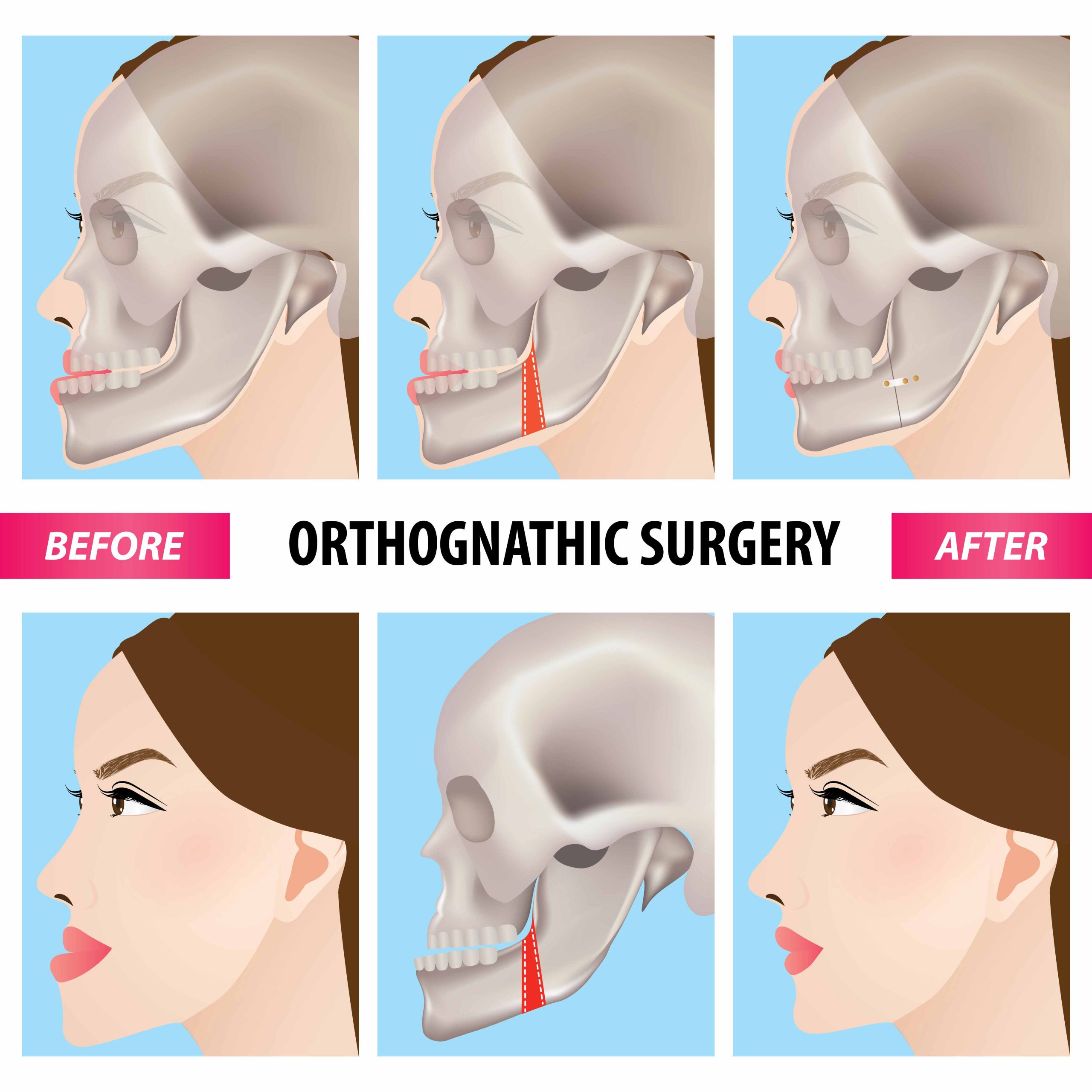 Orthognathic Surgeries