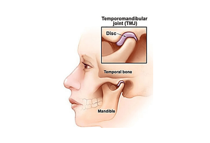 TMJ Disorders