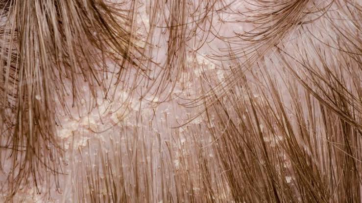 Anti Dandruff Treatment