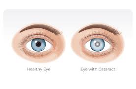 CATARACT
