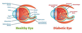 Glaucoma – Causes, Types, and Treatment