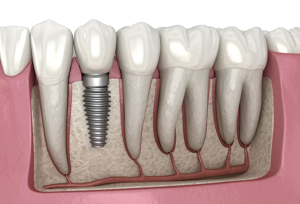Implantology