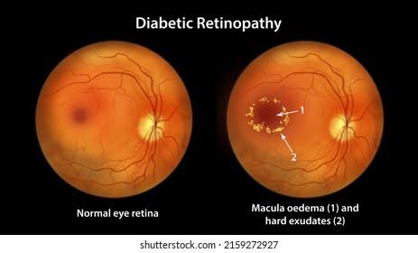 Diabetic Eye Disease Diagnosis (Fundoscopy & Retinopathy)