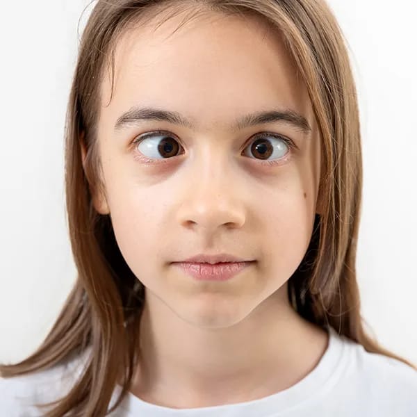 Squint Treatment